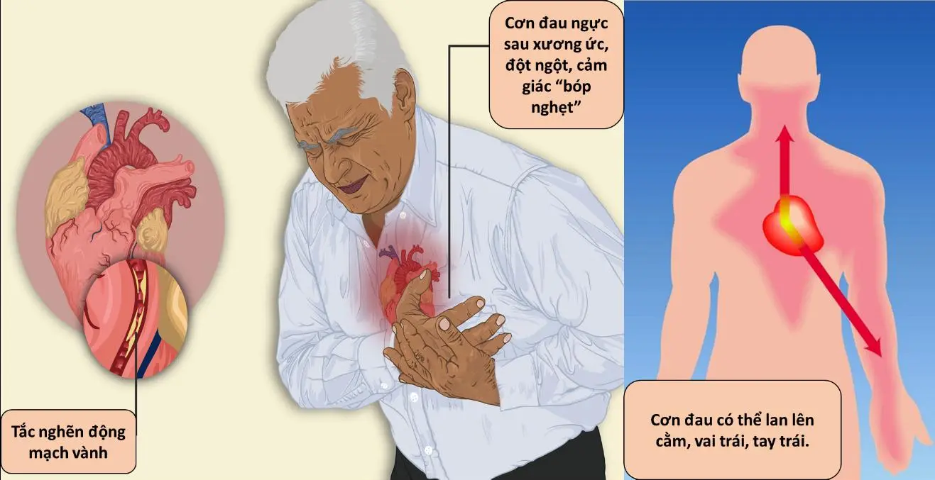 Nhồi máu cơ tim